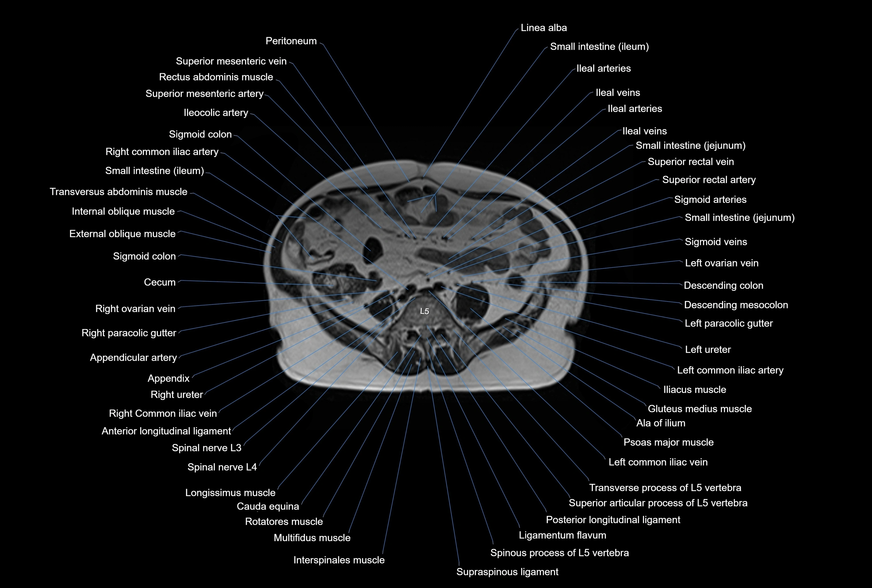MRI Abdomen axial cross sectional anatomy radiology  image-img-00001-00036.webp
